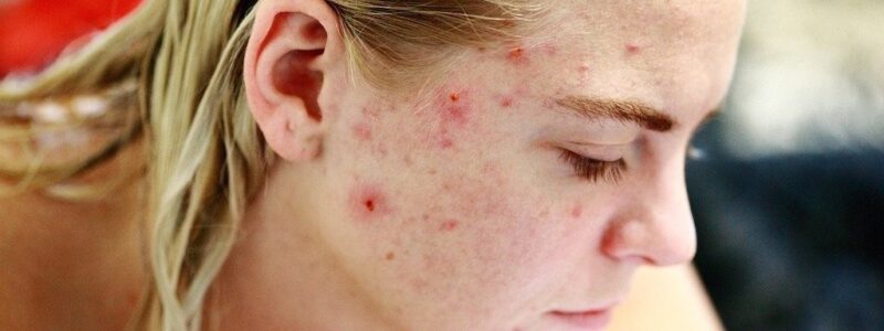 Last van acne? Dit zijn de beste tips om het te verminderen